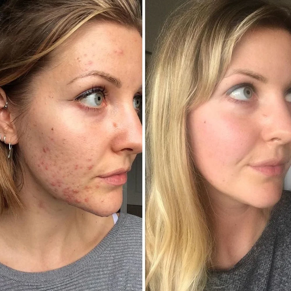 Набор для ухода за кожей лица LANBENA сыворотка с гиалуроновой кислотой патчи от