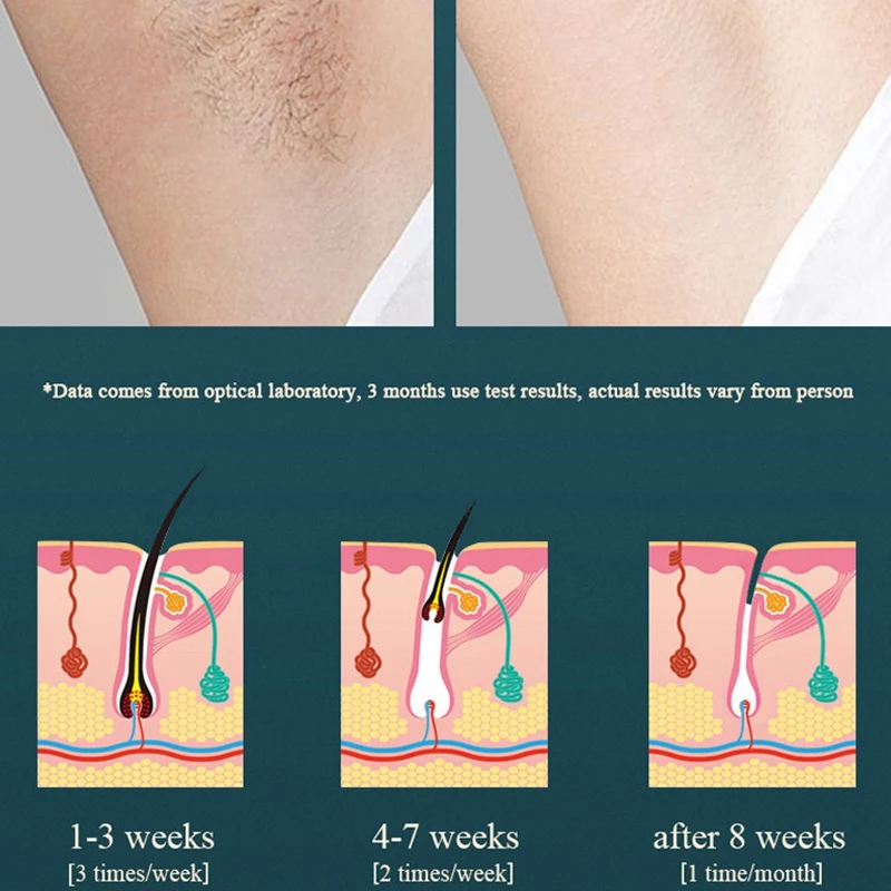 

Ladies IPL Epilator Lasers Epilator 990000 Fash Professional Permanent Painless Epilator EU Plug