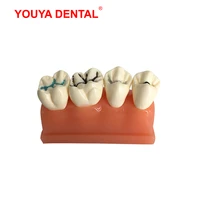 dental model resin 4times pit and fissure sealment tooth modeling for studying teaching medical science oral dentistry products