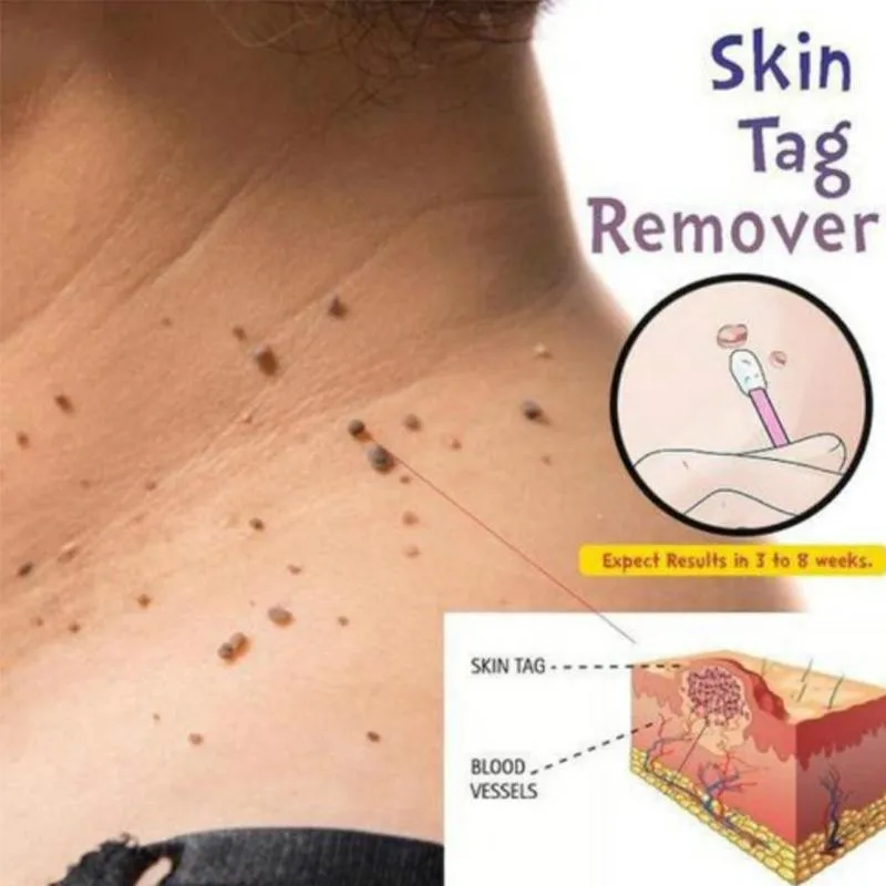 10 мл средство для удаления кожных следов естественное удаление бородавок жидкие