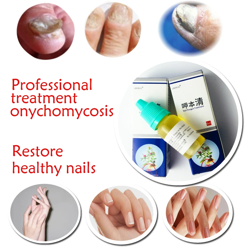 Лечение ногтей Onychomycosis Paronychia противогрибковые инфекция хороший результат