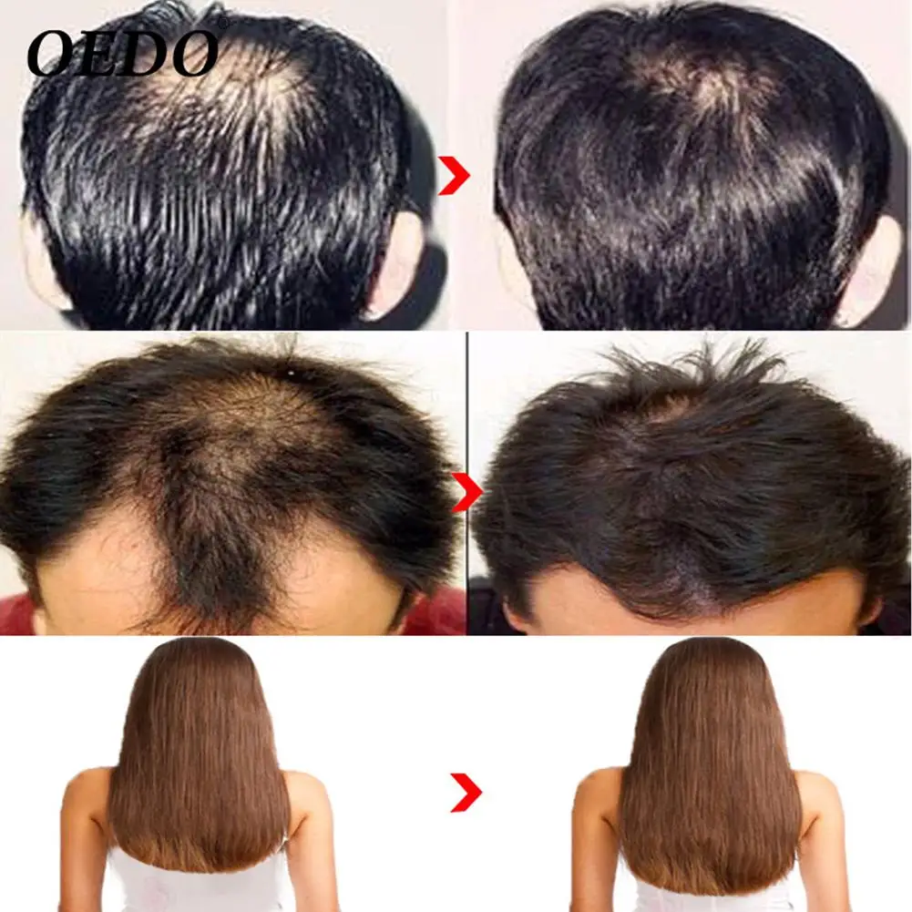 OEDO быстрый рост волос мощная Сыворотка для восстановления травяной женьшень