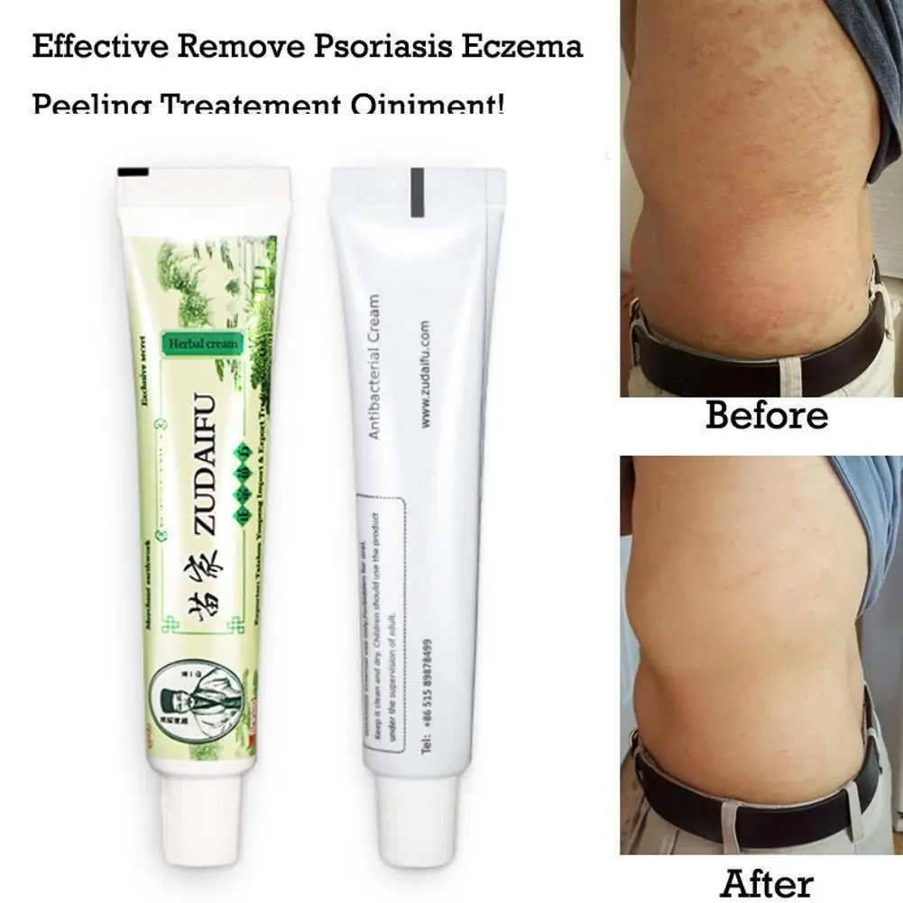 Zudaifu Body Cream Without Retail Box Men Women Skin Care Product Relieve Psoriasis Dermatitis Eczema Pruritus Effect |