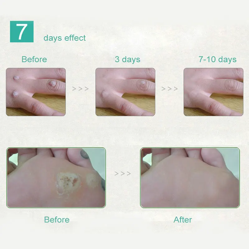 10 мл антибактериальные средства для ног удаляют бородавки омертвевшей кожи