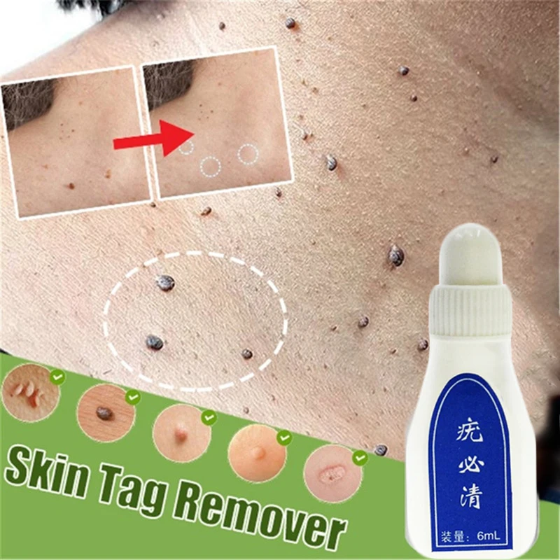 Половых органов для борьбы с пигментацией лечение папилломы удаление бородавки