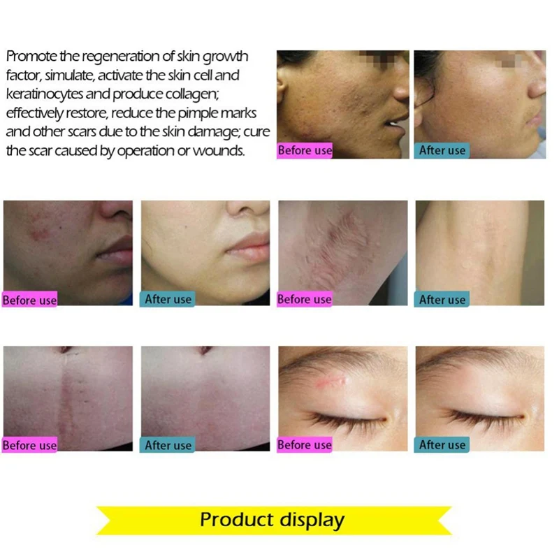 

Face Care Essential Oil Acne Scar Spots Removal Skin Care Whitening Remove Scars Acne Repair Face Cream Essence Oils 30ML