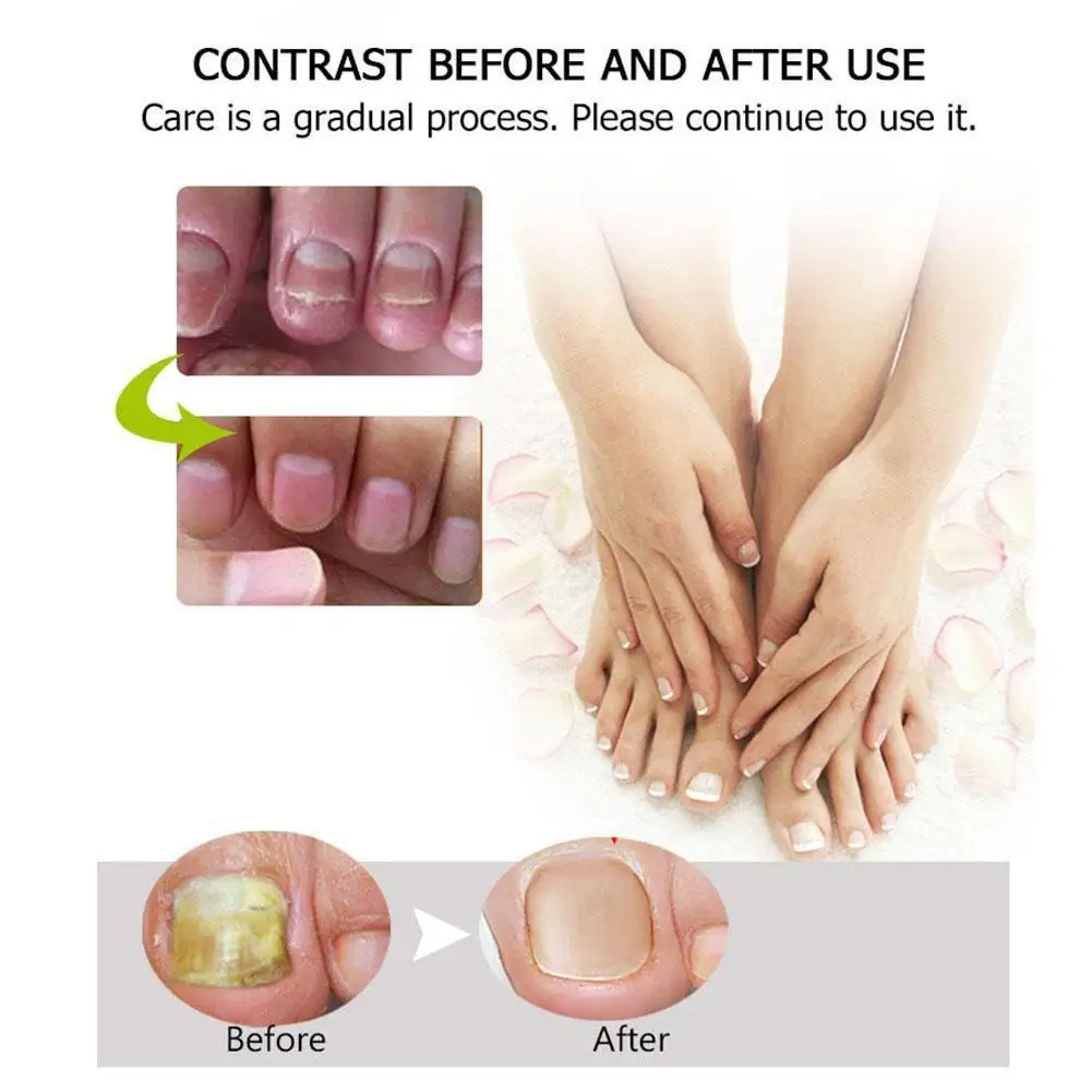 

1Pcs Antibacterial Chinese Natural Herbal Cream Nail Toes Cream Toes Infection Onychomycosis Nails Repair Gel Cream Fungus Y6E4
