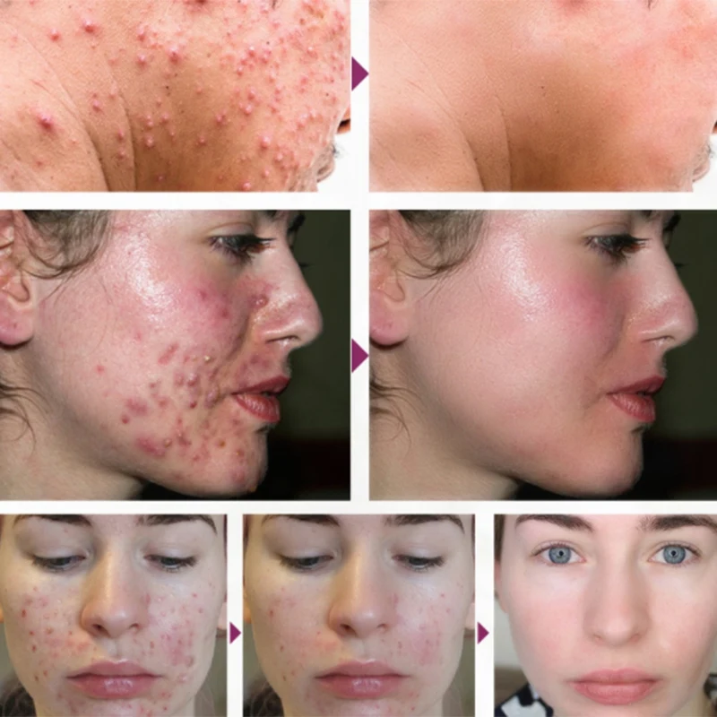 RtopR прополис лечение угрей осветляющая сыворотка акне шрам пятна Очищающая