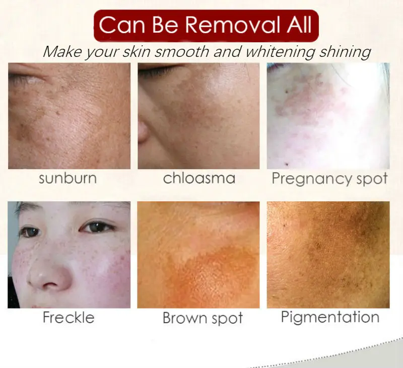Dimollaure Retinol cream Vitamin C peptides serum whitening acne treament Remove Freckle melasma Melanin dark Spots | Красота и