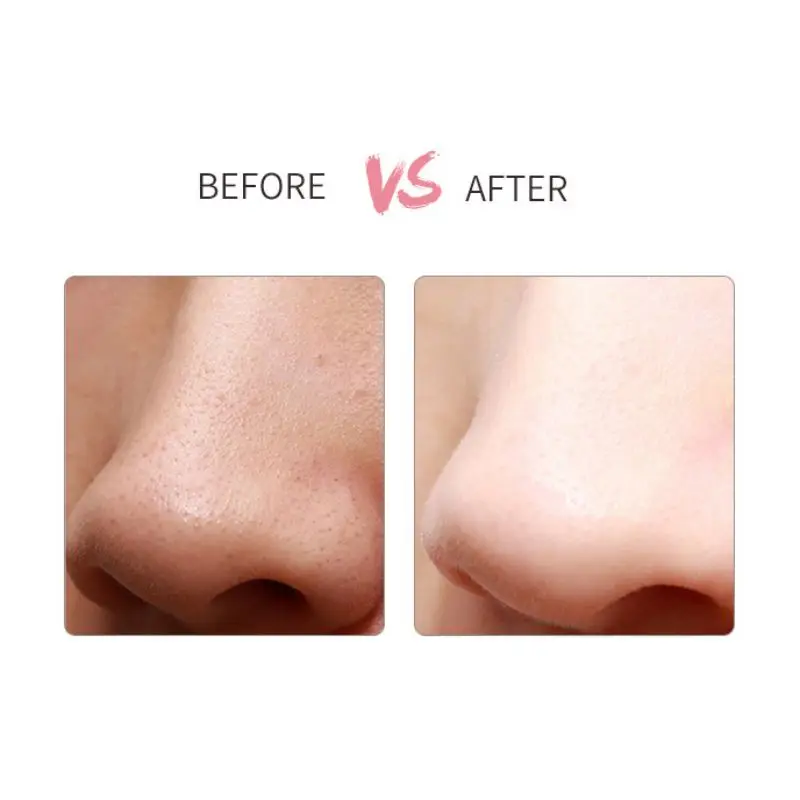 

Blackheads Removal Cleaning Pores Remove Blackheads Pimples Electric Blackhead Remover Beauty Instrument