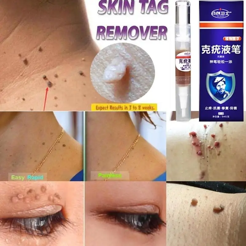 Средство для удаления мозолей на ногах сверхпрочное средство бородавок 12 часов 5