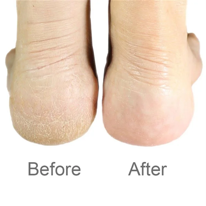 Прямая поставка шлифовка для педикюра двухсторонняя пилка ног терка удаления