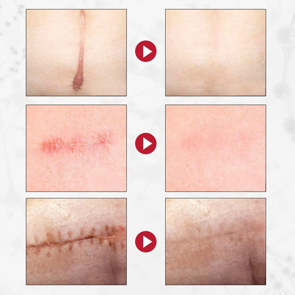 

30ML Acne Scar Removal Cream Pimples Stretch Marks Face Gel Remove Acne Smoothing Whitening Moisturizing Body Skin Care