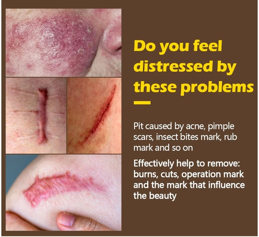 

Stretch mark remover skin care scar cream treatment scar repair skin care body cream 20g