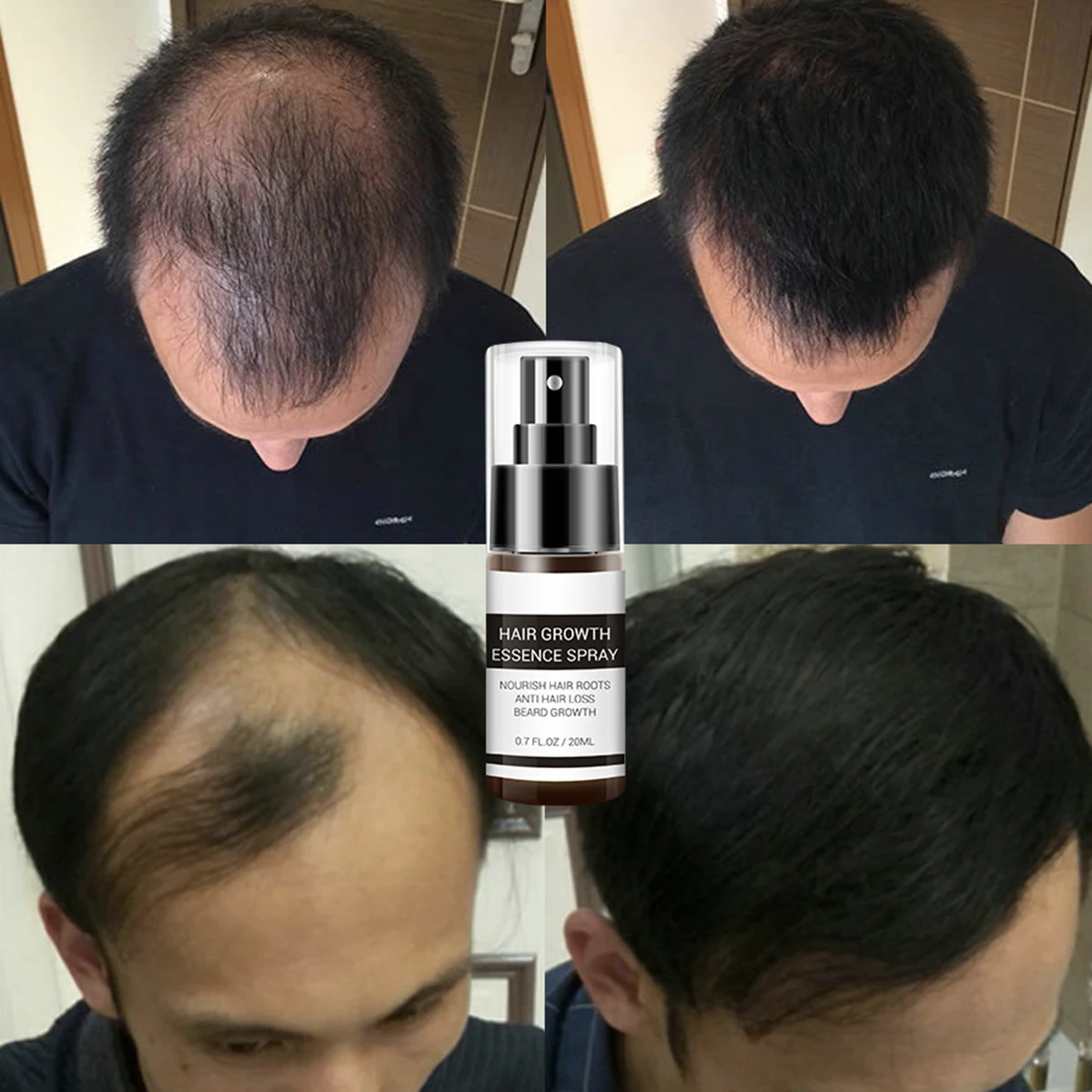 Эссенция для роста волос 20 мл спрей против выпадения лечение питание жидкий Уход