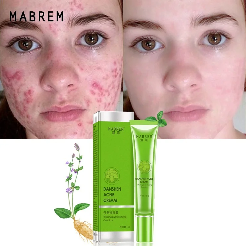 

Acne Removal Cream Acne Treatment Fade Acne Spots Oil Control Shrink Pores Whitening Cream Moisturizing Nicotinamide Skin Care