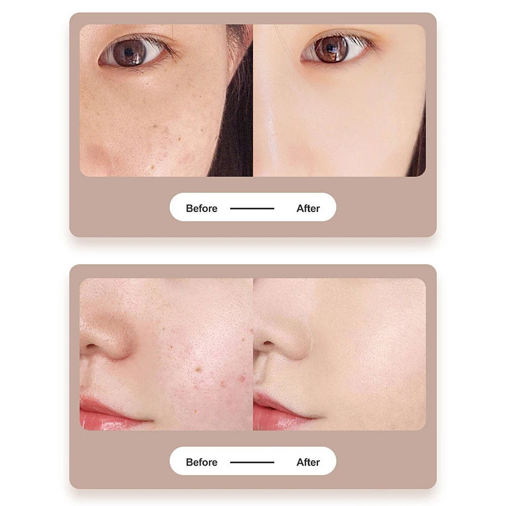 Плазменная ручка плазменная для удаления бородавок моль тату Машинка метка на