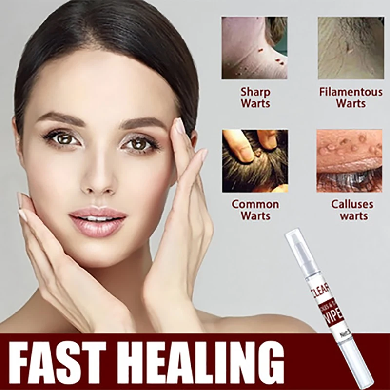 

3ml Genital Wart Treatment Papillomas Removal Of Warts Liquid From Skin Tags Removing Against Moles Remover Anti Verruca Remedy