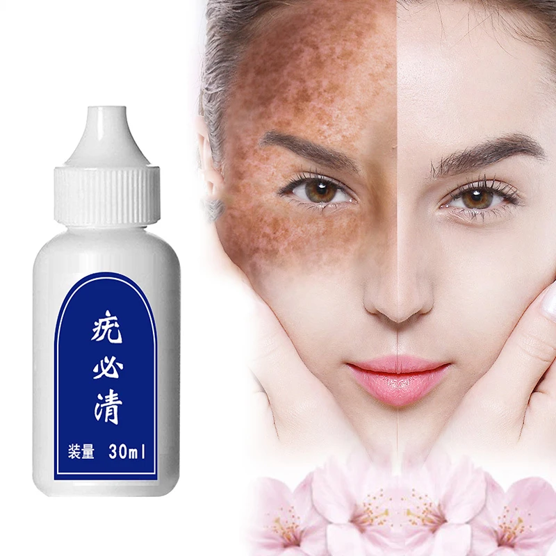 Бирка для удаления бородавок на коже средство лечения гениталий родинок и