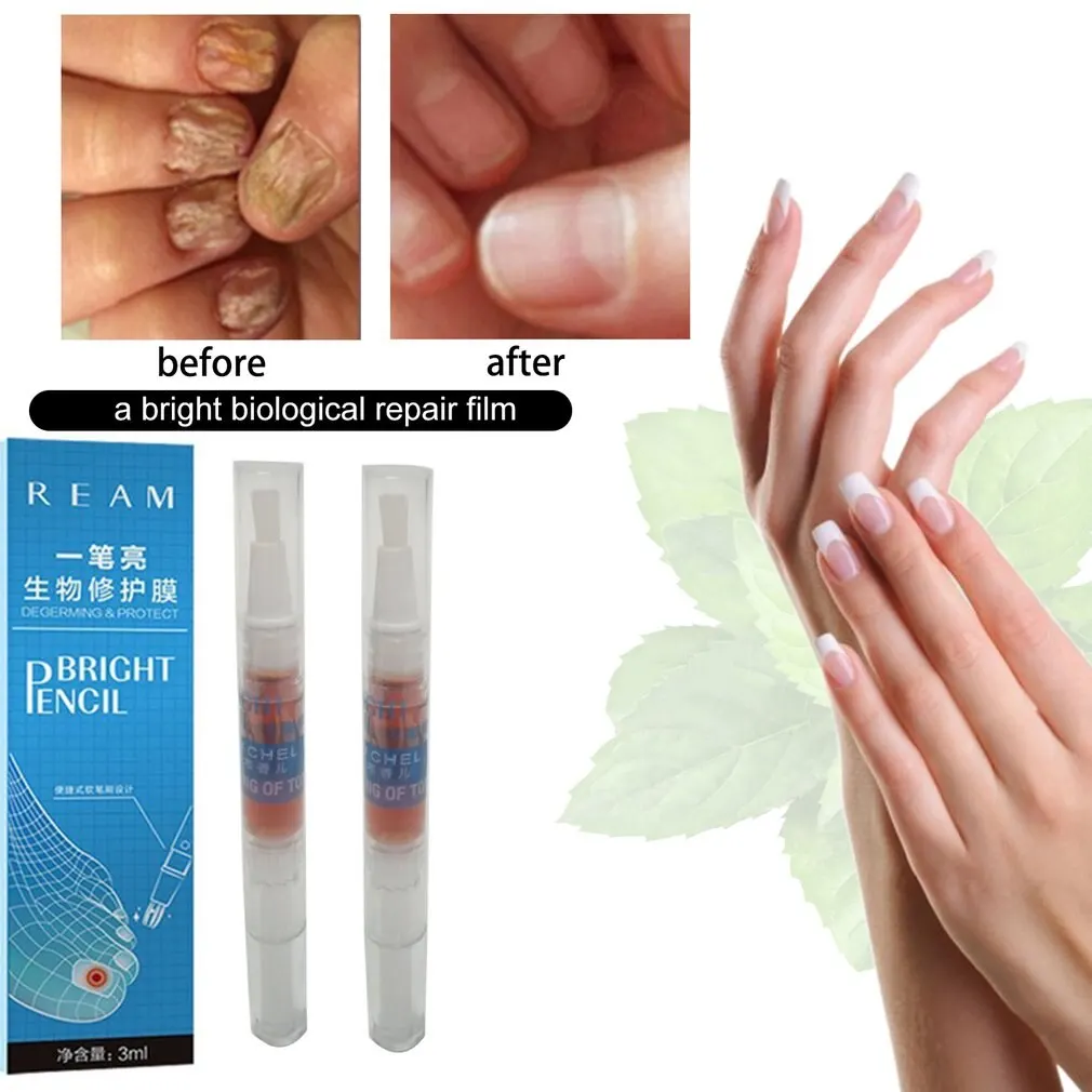 

Fungal Nail Treatment Pen Effective Onychomycosis Paronychia Fungus Infection Repair Solution Gel Fingernails Toenails Care 3ml