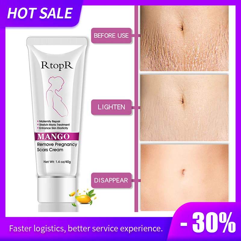 Крем от акне растяжек и следов манго 40 г|Материнство| |