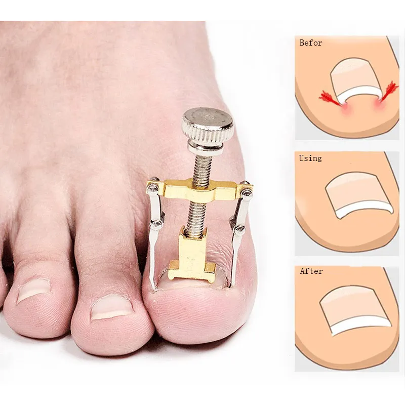 Педикюр ортопедический для вросших ногтей педикюра Уход за ногтями на ногах