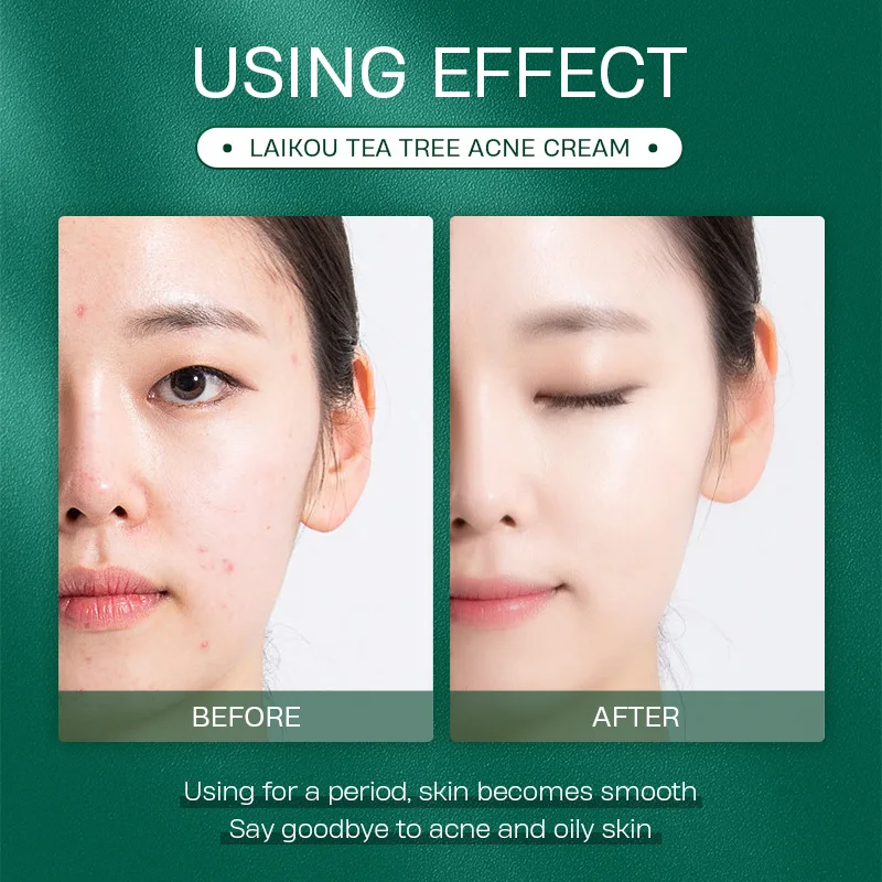 Tea Tree Acne Cream Soothing Removal Oil Control Promote Skin Cell Metabolism And Cure Lncrease Moisture 20g |