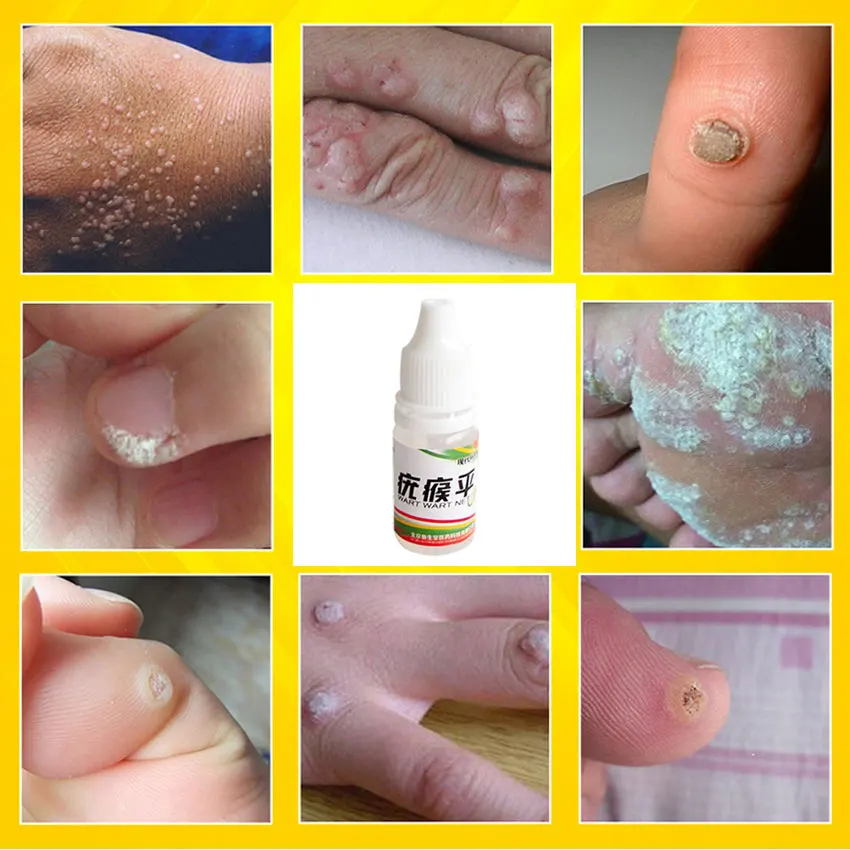 Chinese Medicine Treatment Foot Corn Removal Plantar Warts Pomada De Verruga Care Medical Plaster Ointment | Красота и здоровье