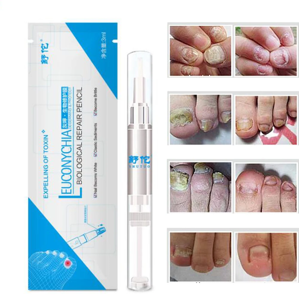 

Kills 99.9% Bacteria Nail Fungus Oil Onychomycosis Paronychia Anti Fungal Nail Infection Repair Patch Nail Care Treatment 3CT023