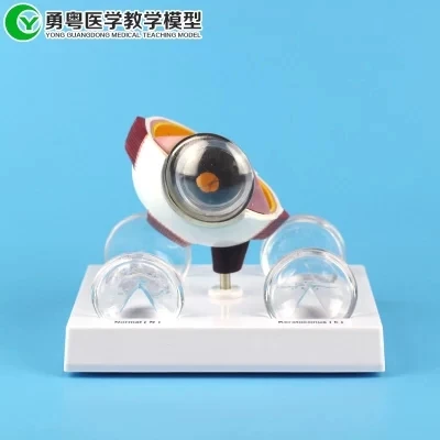 Anatomic model of eyeball Ocular corneal disease pathological model