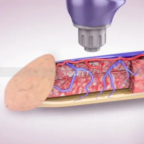 2020 новая система экстракорпоральная ударная волновая терапия машина