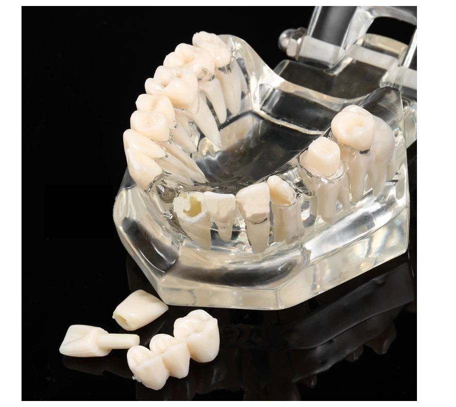 Горячая Распродажа зубной имплантат прозрачная модель удаляемых патологических