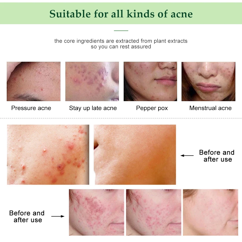 Пятна Отбеливание акне крем Женский гель для лица Восстанавливающий выцветающий