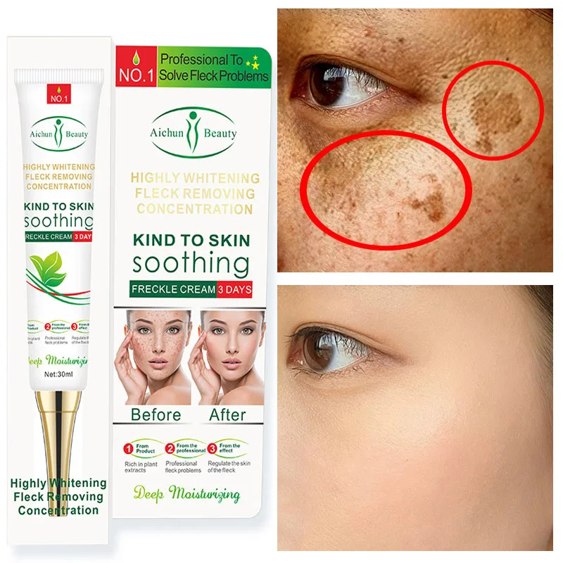 

Whitening Freckles Cream Remove Effective Melasma Acne Spot Pigment Melanin Dark Spots Pigmentation Moisturizing Gel Skin Care