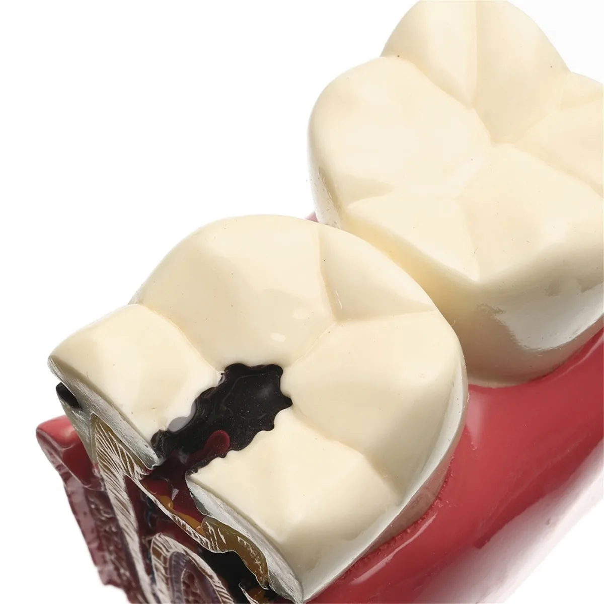 Новинка 1 шт. 6X протеза модель кариеса сравнительная Стоматолог патологий для