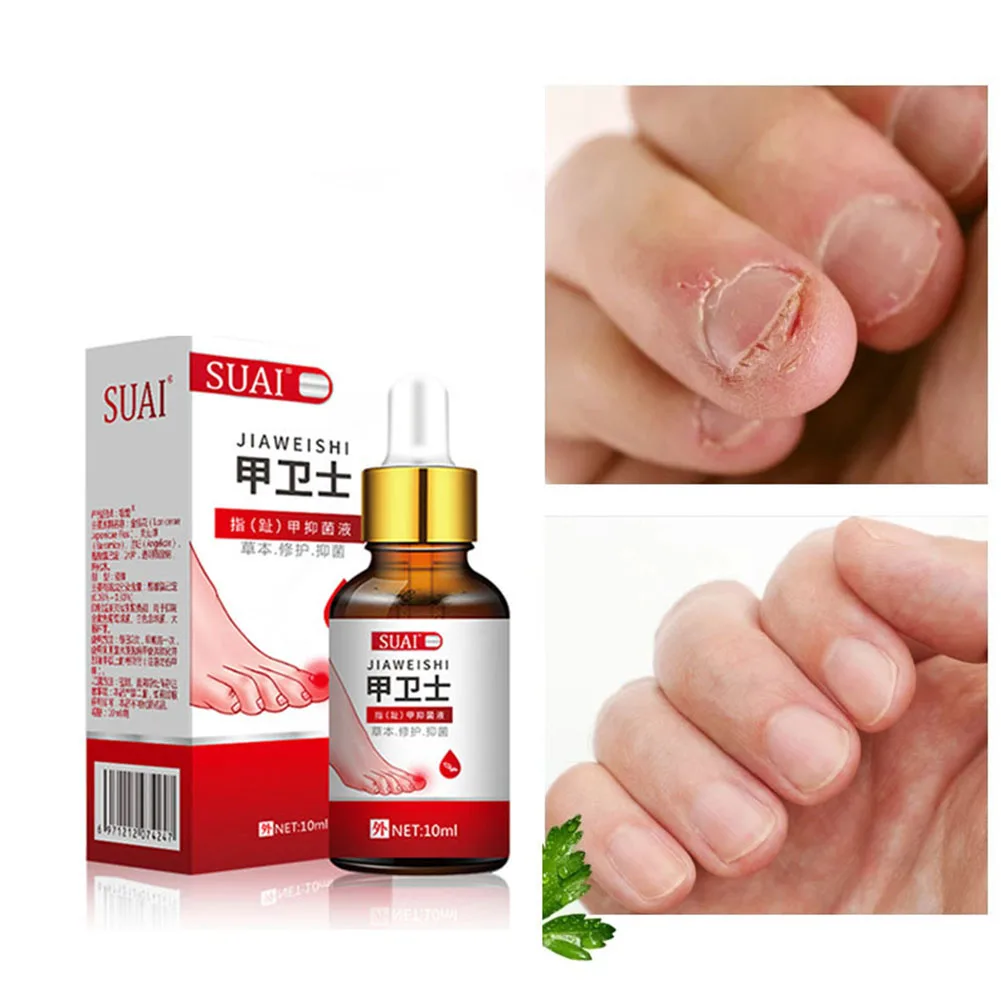 

Hot sell Fungal Nail Repair Essence Serum Treatment Care Foot Nail Fungus Removal Gel Anti Infection Paronychia Onychomycosis