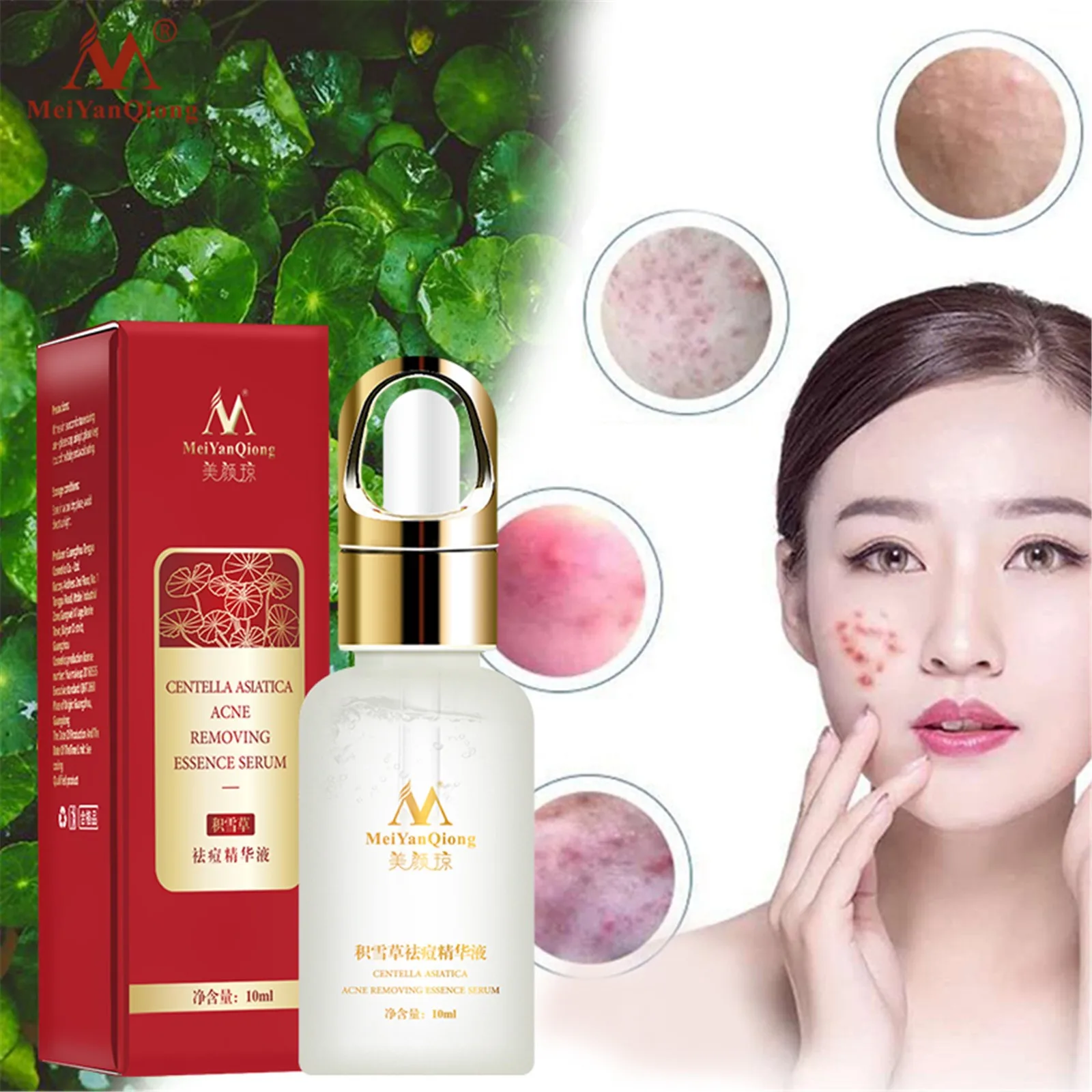 Лечение акне уход за кожей лица Сыворотки центеллы азиатской масляный