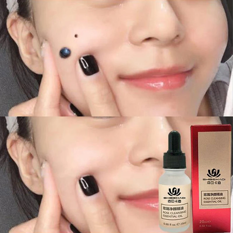

20ml Remove Mole Essential Oil Painless Free Potion Repair Face Wart Tag Freckle Skin Care Essential Oil