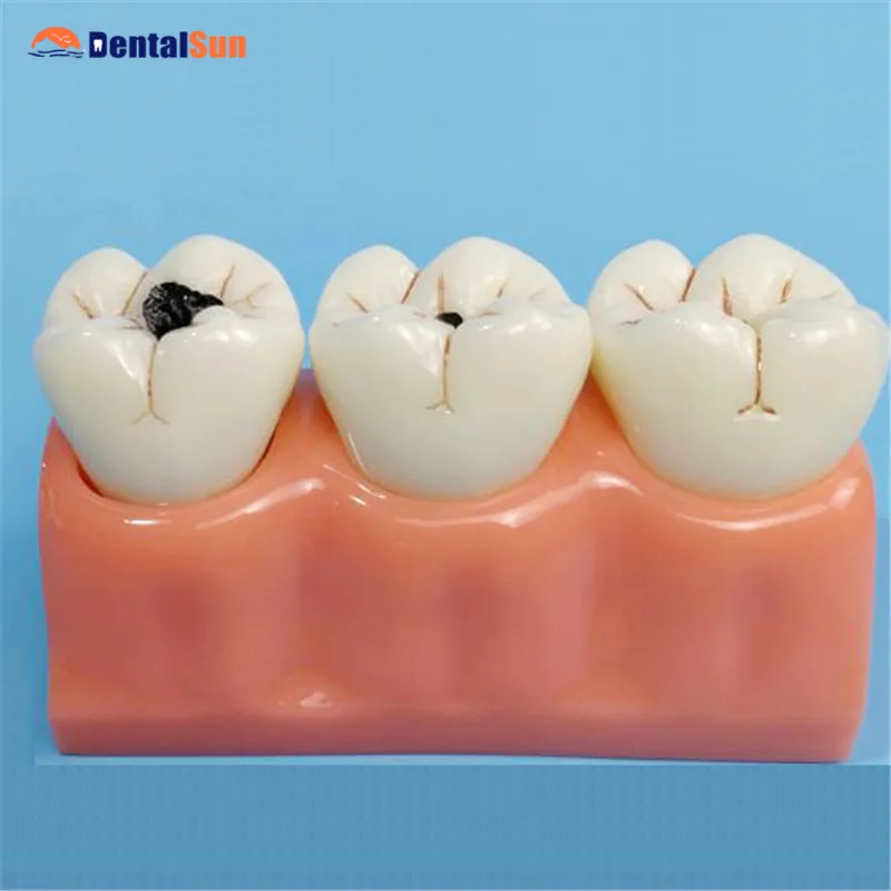 

Dental Training Model 4 Times Larger Caries Development Model