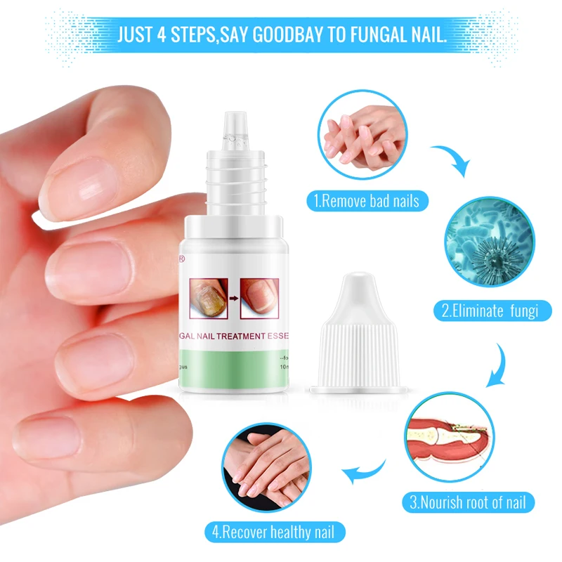 

OMY LADY Fungal Nail Repair Serum Toe Nail Fungus Treatment Nails Gel Anti Infection Paronychia Onychomycosis Nails Essence Care