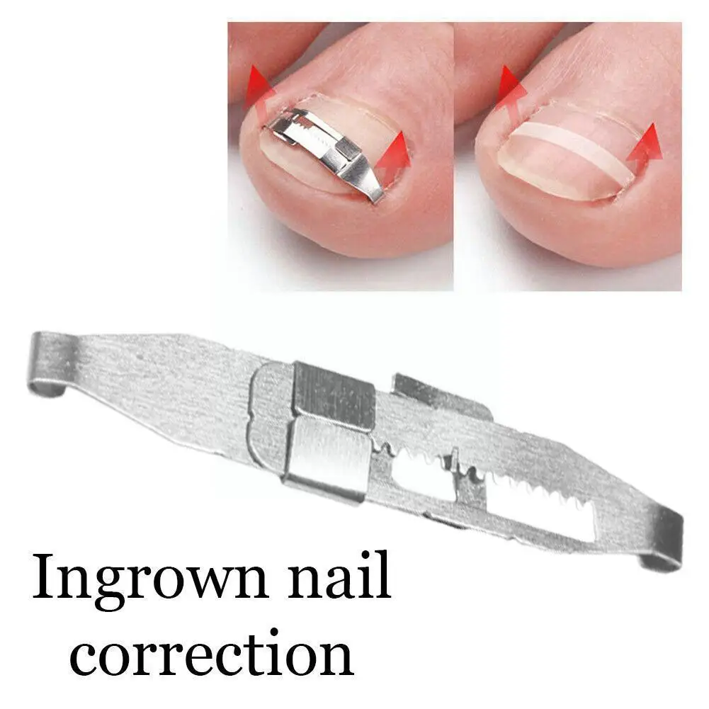 

Ingrown Toenail Pedicure Tools Professional Recover Treatment Toe Nail Paronychia Valgus Foot Corrector Care Hallux Bunion