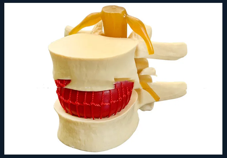 

Demonstration model of medical human lumbar disc herniation lumbar model spinal model spinal model orthopedics department