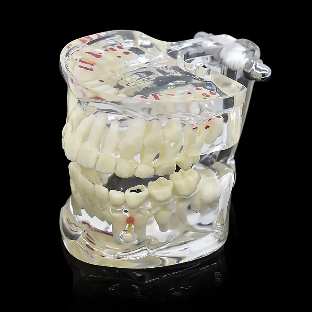 Стоматологическая детская модель патологических зубов Ортодонтическая для