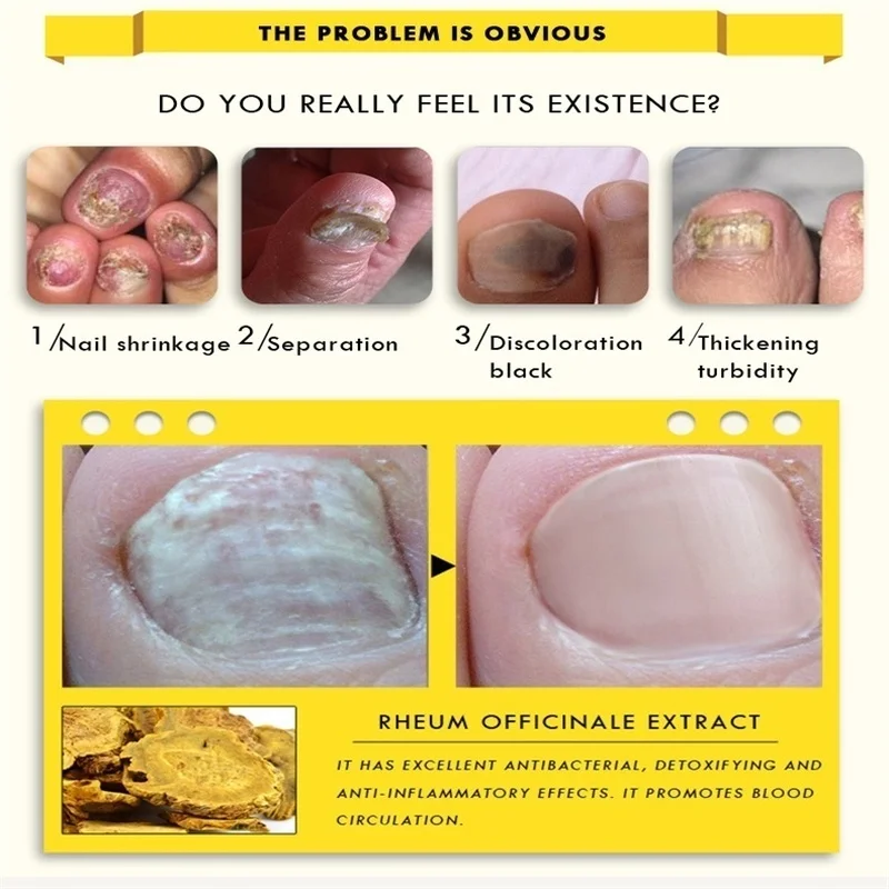 1 шт. бактерицидная натуральные эфирные масла для ногтей жидкость ремонт лечения