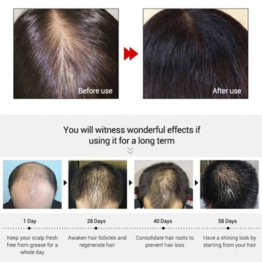 Эссенция для роста волос масло продукты быстрого уход за кожей головы лечение