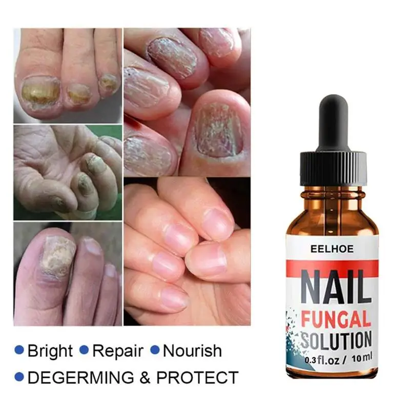 

Nail Repair Liquid Hand And Foot Onychomycosis Care Liquid Thickening Onychomycosis Nail Antibacterial Soft Repair M6J9