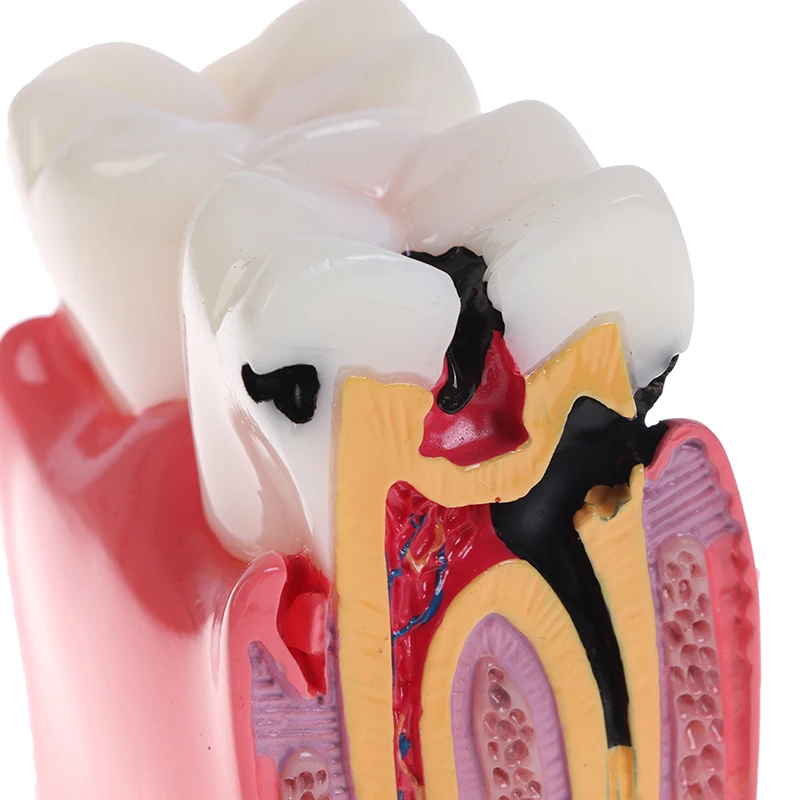 

Dental Teeth Model 6 Times Caries Comparation Study Denture Tooth Models