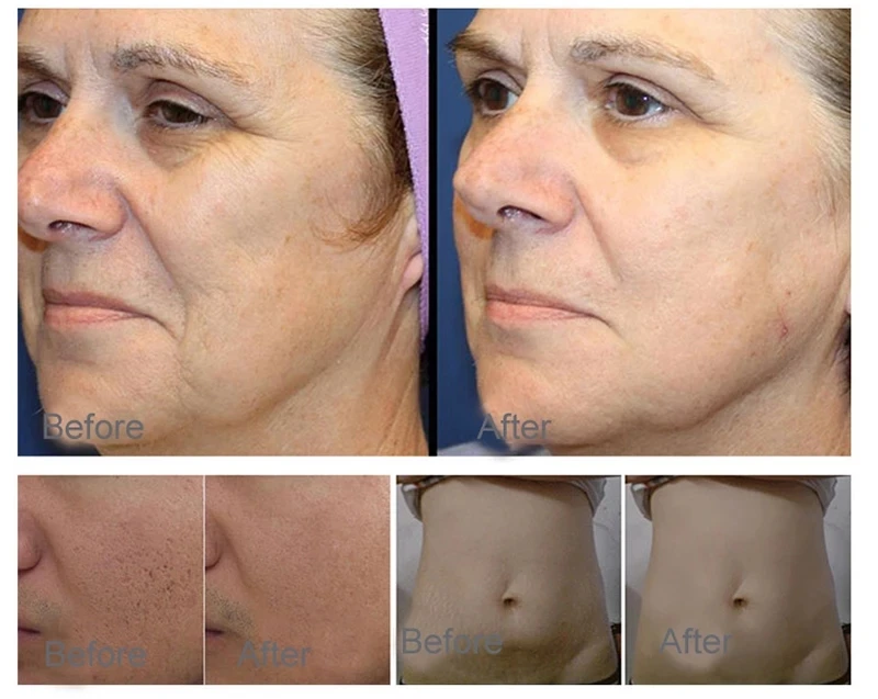 

Portable 2IN1 Plasma Professional Use Hot and Cold Plasma Lift Skin care Wrinkle-removing anti-aging lift firming machine