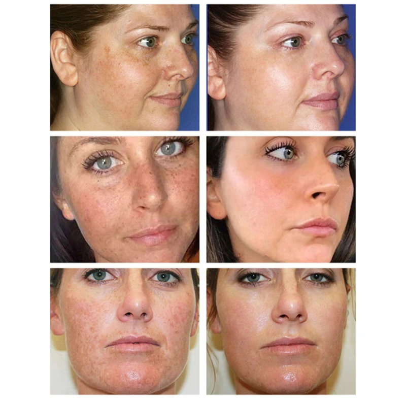 

Strong Whitening Cream Freckle Cream Remove Melasma Acne Dark Pigment Spots Melanin Pimple Cream Face Brightening skin Care