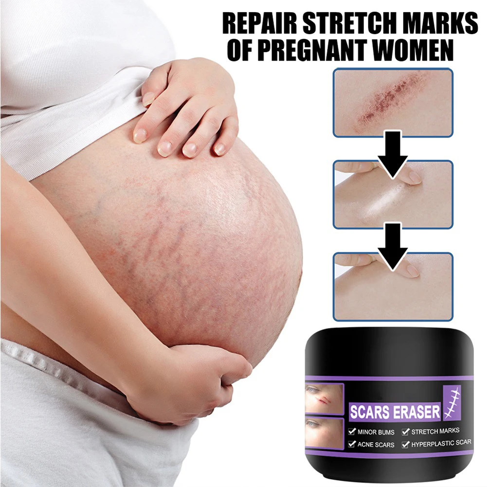 

New Acne Scar Removal Cream Pimples Stretch Marks Skin Repair Treatment Smoothing Whitening Moisturizing Body Skin Care